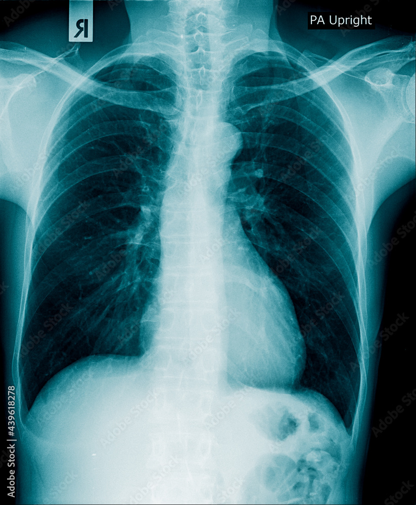 Poster chest x-ray image with lung view in blue tone on black background