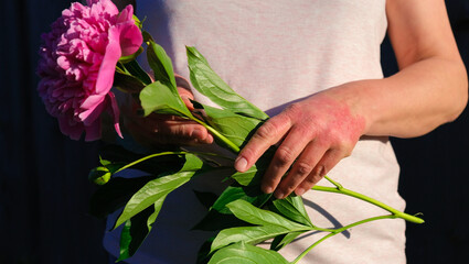 A woman with psoriasis in her arms, holding a peony flower.