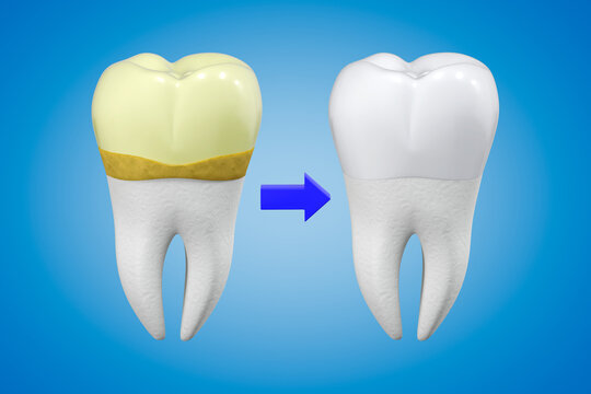 The concept of professional tooth cleaning. A tooth with yellow plaque and calculus and a white tooth with shiny enamel in comparison. 3d rendering.