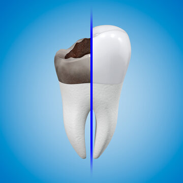 The concept of prosthetics for a damaged tooth with a metal-ceramic crown. Carious tooth and dental crown. 3d rendering.