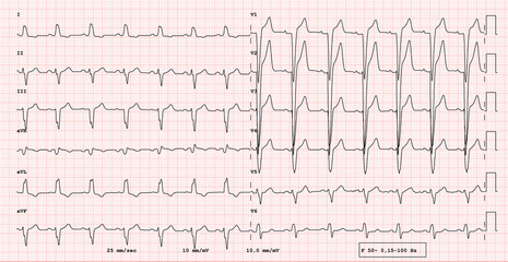 ECG example of  12-lead rhythm,  left bundle branch block, real exam
