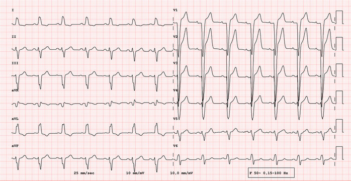 ECG Example Of  12-lead Rhythm,  Left Bundle Branch Block, Real Exam