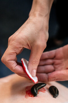 Medicinal Leech Throwing Up Blood