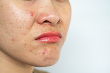 Obraz premium Cropped shot of woman having problems of acne inflamed on her face. Inflamed acne consists of swelling, redness, and pores that are deeply clogged with bacteria, oil, and dead skin cells.