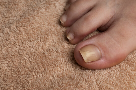 Toenail fungus or onychomycosis on a girl's foot