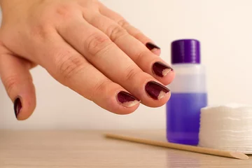 Tuinposter Damaged female manicure. Peeled polish with nails. Home manicure concept. Home manicure in quarantine. Dry skin with brittle splitting  © Natallia