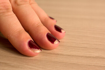 Damaged female manicure. Peeled polish with nails. Home manicure concept. Home manicure in...