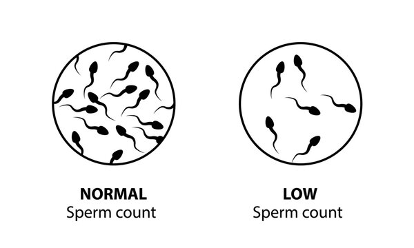 Spermogram. The number of spermatozoa