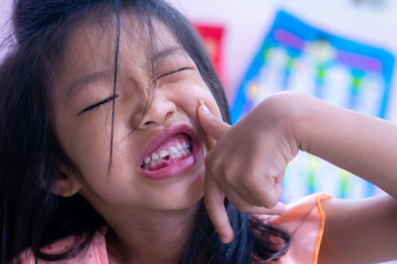 A 5-year-old Asian girl broke her first tooth.