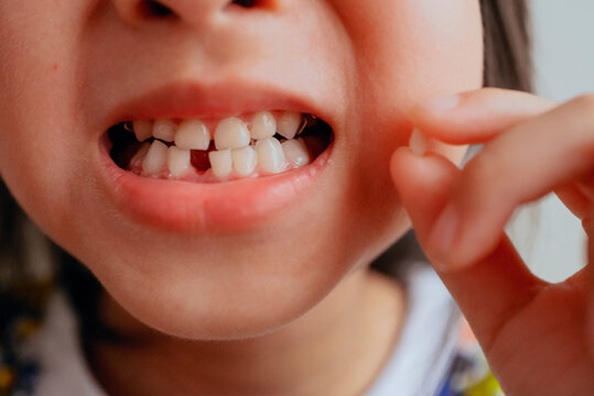 Little girl lost her first tooth