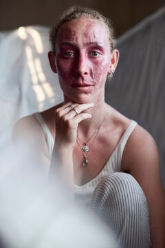 Beauty portrait of a young woman with a red birthmark on her fac