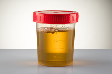 Container with collected sample. Medical tests. Analysis of urine. Drug test.