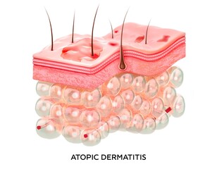 Eczema. 3d illustration of the cross-section of skin layers with atopic dermatitis. Damaged skin. - obrazy, fototapety, plakaty