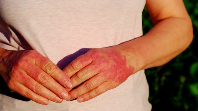 Woman strokes her hands affected by psoriasis. High quality 4k footage
