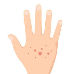 Rash on hand cartoon vector. free space for text. copy space.