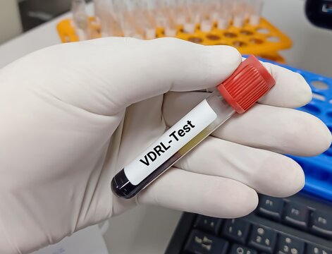 Biochemist or Lab Technologist holds Blood samples for VDRL ( venereal disease research laboratory) test, diagnosis for syphilis infection in the laboratory background.