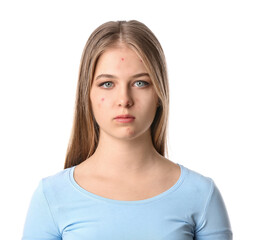 Teenage girl with acne problem on white background
