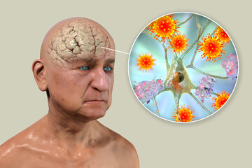 Infectious etiology of dementia. Viruses that affect neurons - obrazy, fototapety, plakaty