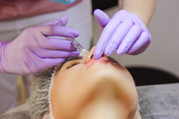 Obraz na płótnie Canvas Lip augmentation procedure. A beautiful patient woman getting filler injection, botox. A beautician injects collagen, hyaluronic acid, silicone through a syringe. A cosmetologist wearing purple gloves