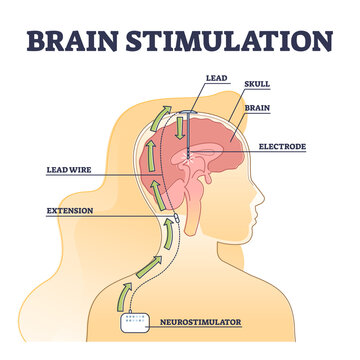 Deep brain stimulation procedure educational explanation outline diagram. DBS process example with head surgical neurostimulator electrodes implantation vector illustration. Disorders treatment scheme