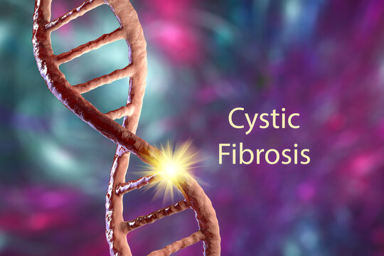 Cystic fibrosis, a genetic disorder caused by mutation in the CFTR gene, 3D illustration