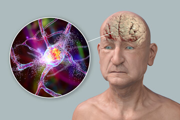Dementia and Alzheimer's disease medical concept, 3D illustration