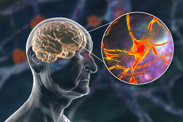 Dementia and Alzheimer's disease medical concept, 3D illustration. Memory loss, brain aging - obrazy, fototapety, plakaty