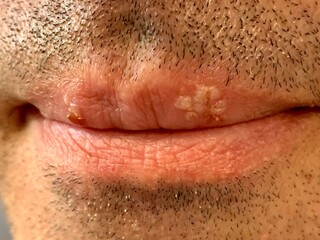 Herpes on the lips of a man close-up.