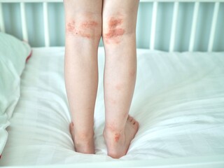 Eczema on kid's legs. Atopic dermatitis close up. Allergy spots and red itchy skin inflammation on...