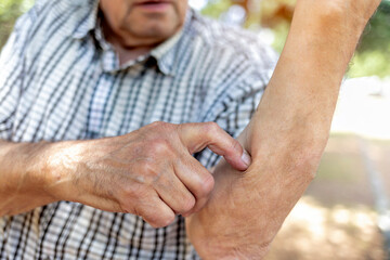 Cropped shot of an insect bite on arm of a senior man. Irritated caucasian male person with redness on his arm from an insect bite at the park on a summer day. He looks in pain and scratching.