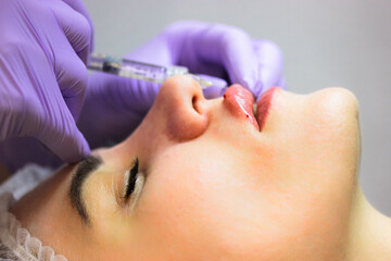 Obraz na płótnie Canvas A cosmetologist injects a hyaluronic acid-based filler into the patient's lips. The process of lip augmentation in a young beautiful woman. A nurse is wearing purple rubber gloves. Beauty injections.