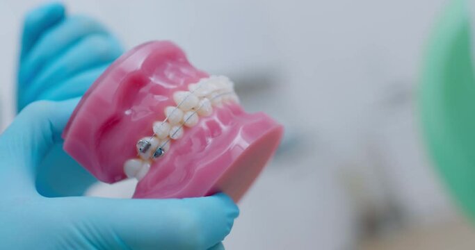 Close-up jaw model of ceramic teeth with a bracket system that is holding a medical worker.