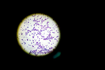 Staphylococcus aureus infected in aged patient, showing of gram's stain from positive hemoculture.