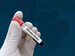 Biochemist or Lab Technologist holds Blood samples for the Direct Bilirubin test in the laboratory...