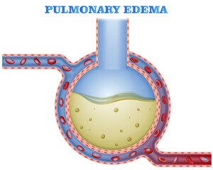 Alveoli filled with fluid, pulmonary edema, pneumonia, gas exhange during lung disease - obrazy, fototapety, plakaty