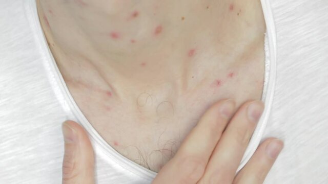 Body of adult  man have spotted, red pimple and bubble rash from chickenpox or varicella zoster virus