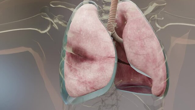 Pneumothorax, Normal lung versus collapsed,  symptoms of pneumothorax, pleural effusion,  empyema, complications after a chest injury, air in the pleural space between the lung and the chest wall, 3d