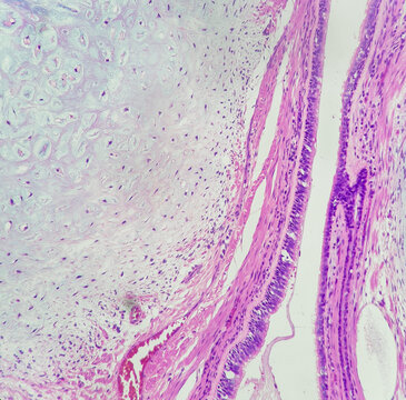 Photo of pulmonary hamartoma, focus on cartilage, magnification 200x, photo under microscope