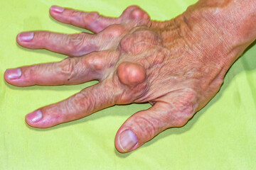 Old age and illnesses of pharmaceutical medicament severe gout in men suffering from joint pain, bone pain, gout ,arthritis ,arm, foot, knee, rheumatoid symptoms, Concept of abstract pain and despair