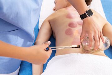 Cupping Therapy. Young female physiotherapist applying glass suction banks on back of her patient, during cupping therapy, closeup detail.