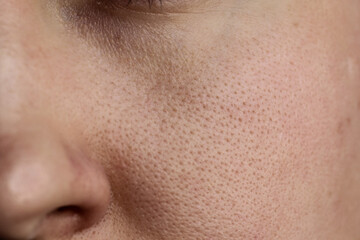 The texture of the pores of the skin of the cheeks and the area under the eyes of the girl.