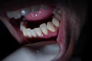 dentist wearing white gloves opening man's mouth for treatment