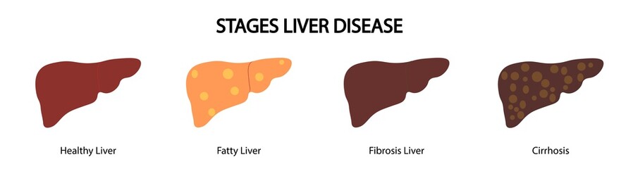 Stages Liver Disease. Normal and Illness liver illustration. Cirrhosis, Fatty liver,  Fibrosis liver