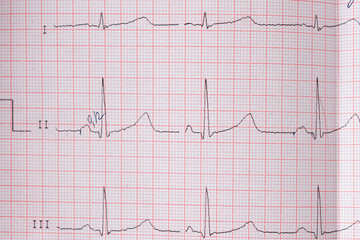 Heart electrocardiogram EKG chart on special paper. Concept for heart scan, health insurance, medical background, examination.