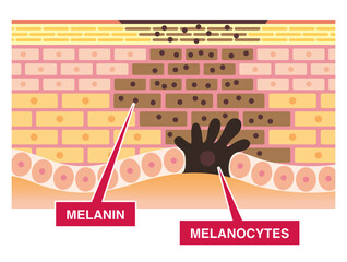 Spotted skin cross section. Melanin and melanocytes. Adverse effects of ultraviolet.  Pale colored illustration in flat cartoon style.