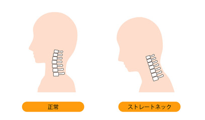 ストレートネック（スマホ首）と正常な首の骨のイメージ