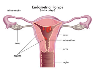 Medical illustration shows a female reproductive system with endometrial polyps, with annotations. - obrazy, fototapety, plakaty