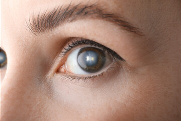 Fototapeta na wymiar Closeup view of woman suffering from cataract