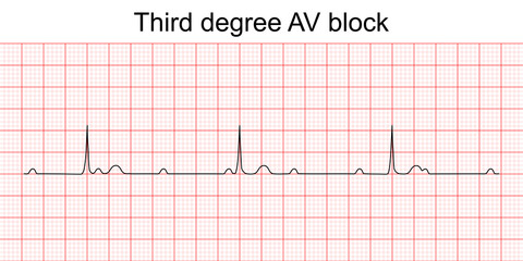Electrocardiogram show third degree (complete) AV block pattern. ECG. EKG. Vital sign. Heart beat. Life line. Medical healthcare symbol.
