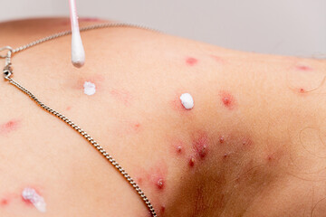treatment of ulcers from chickenpox, varicella with medical cream